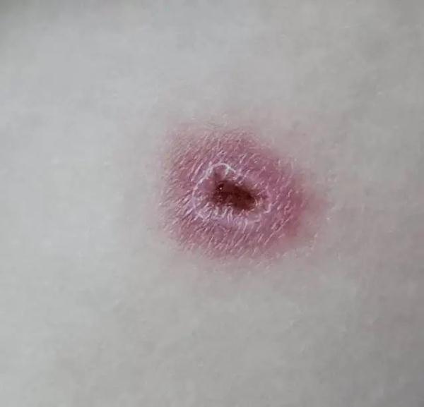 知名女演员自曝：“持续刺痛”！近期很多人中招