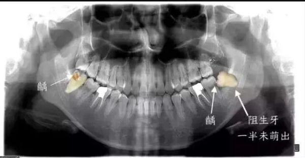 小伙拔智齿后晕倒,开颅手术14天后去世!网友担心:还能拔吗? 小伙拔智齿后晕倒,开颅手术14天后去世!网友担心:还能拔吗?