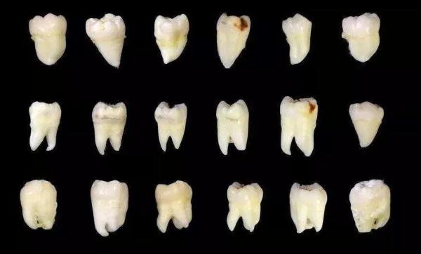 小伙拔智齿后晕倒,开颅手术14天后去世!网友担心:还能拔吗? 小伙拔智齿后晕倒,开颅手术14天后去世!网友担心:还能拔吗?