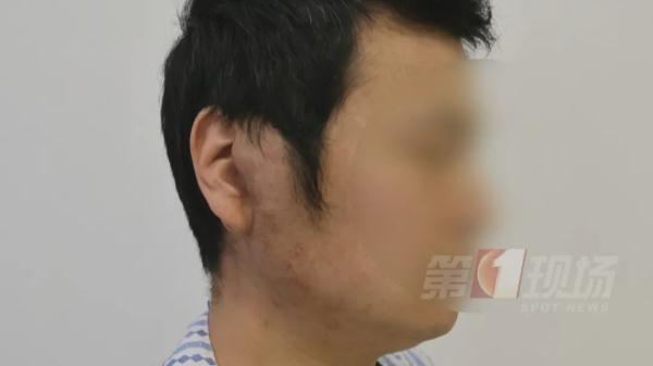 全球患者仅500多！男子右脸肿成“鹌鹑蛋”，原来是这罕见病…
