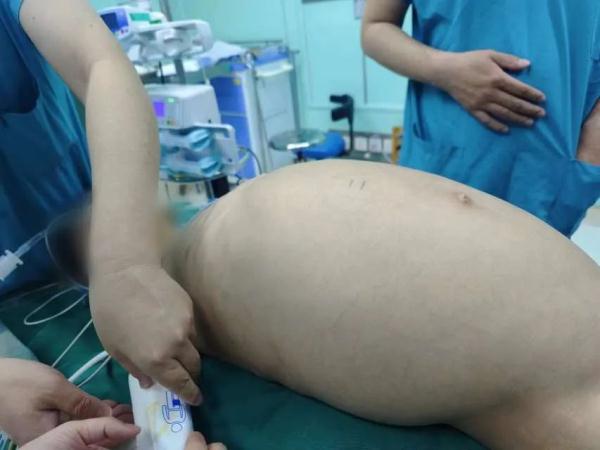 每天开塞露隔天要灌肠,巨结肠危象患儿在首儿所获新生 每天开塞露隔天要灌肠,巨结肠危象患儿在首儿所获新生