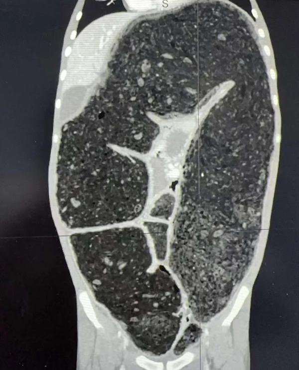 每天开塞露隔天要灌肠,巨结肠危象患儿在首儿所获新生 每天开塞露隔天要灌肠,巨结肠危象患儿在首儿所获新生