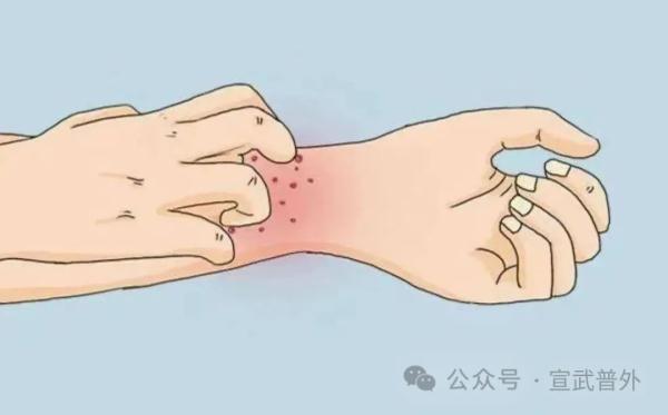伤口处结痂发痒怎么办？