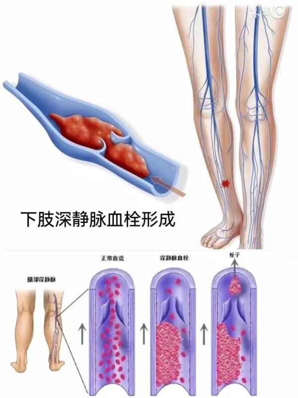 注意!春运路上,久坐或导致血管“堵车”!两个动作教你预防→ 注意!春运路上,久坐或导致血管“堵车”!两个动作教你预防→