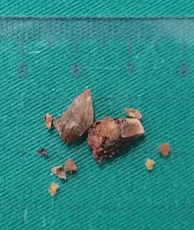 太凶险!4岁男孩突然窒息!近期要特别当心→ 太凶险!4岁男孩突然窒息!近期要特别当心→