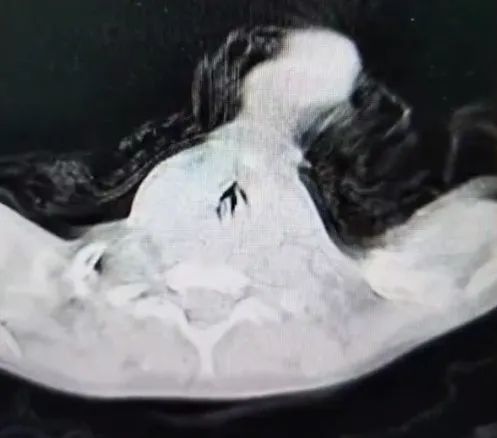 太凶险!4岁男孩突然窒息!近期要特别当心→ 太凶险!4岁男孩突然窒息!近期要特别当心→