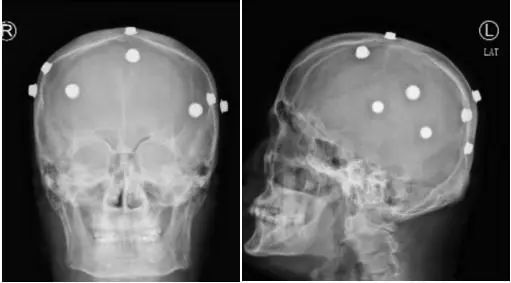 头颅x片显示李大哥的头皮布满了"金属异物"据了解,早在2002年,安徽