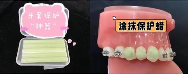 假期吃“嗨”了,牙箍上的“小铁片”掉了怎么办? 假期吃“嗨”了,牙箍上的“小铁片”掉了怎么办?