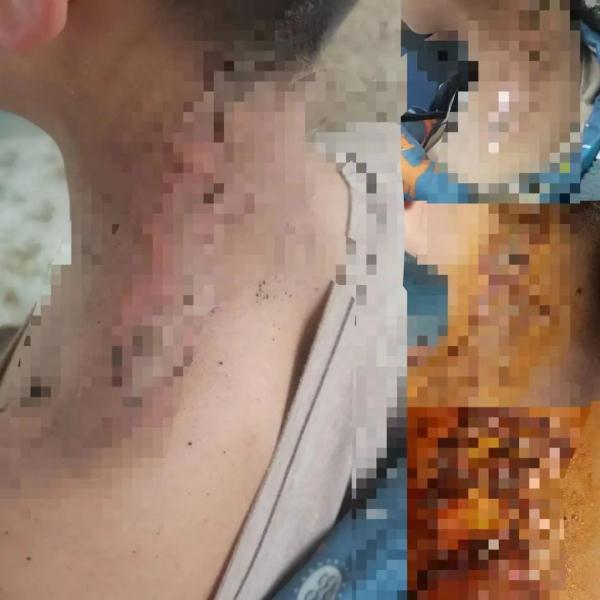 男童把烟花扔进小孩脖子致烧伤,双方家属为治疗问题起争执 男童把烟花扔进小孩脖子致烧伤,双方家属为治疗问题起争执