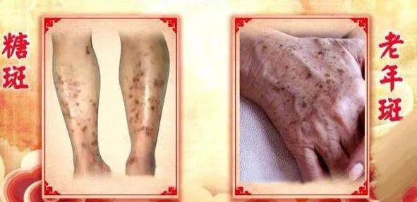 想想都可怕,腿脚有这五个信号,可能有糖尿病了! 想想都可怕,腿脚有这五个信号,可能有糖尿病了!