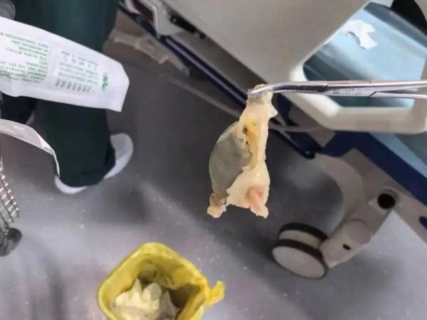 危险！镇江一老人险丧命！只因吃河豚时……