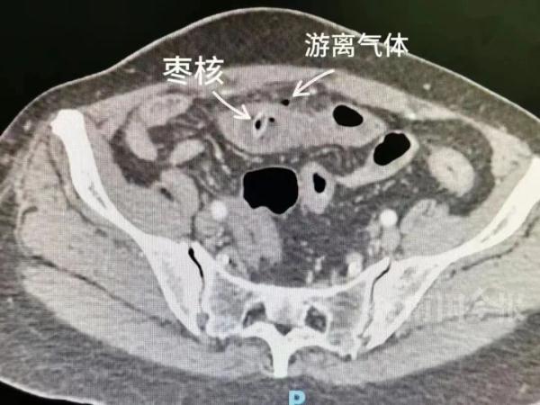 一杯养生茶,让女子肠穿孔!紧急提醒…... 一杯养生茶,让女子肠穿孔!紧急提醒…...