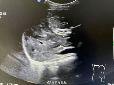 24岁妈妈确诊肝癌晚期崩溃痛哭，孩子才3岁！医生叹息，3年前就有症状