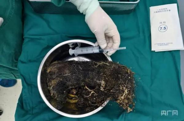 爱吃头发，女孩胃里取出1.3公斤“毛石”……