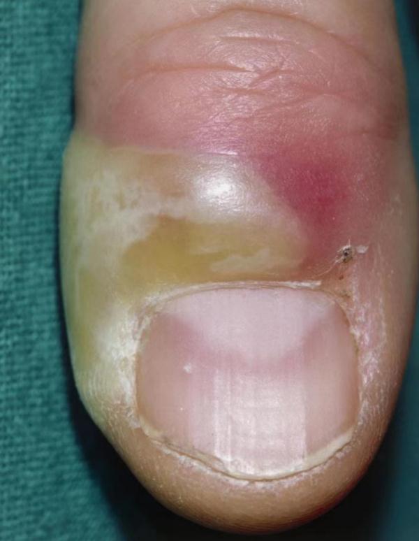 过年连打3天麻将，男子进了医院！问题竟出在指甲上