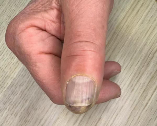 过年连打3天麻将，男子进了医院！问题竟出在指甲上