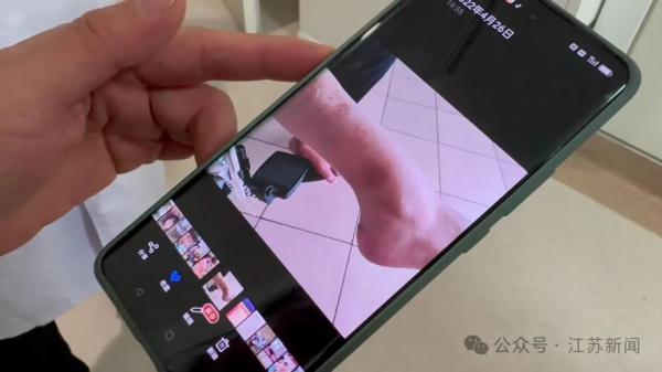 无痛觉不出汗，反复骨折啃咬手指！姐妹俩同患这种罕见病……家人崩溃