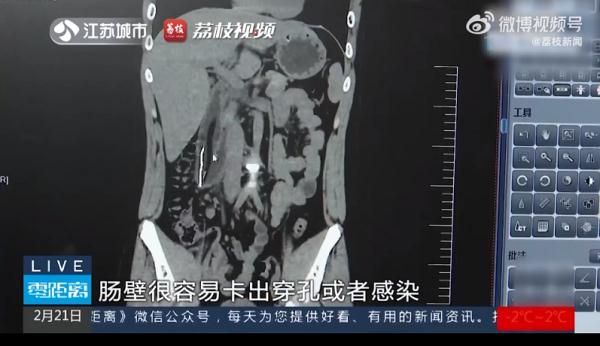 7岁孩子将黄豆塞入耳朵，三个月后已发芽……医生提醒→