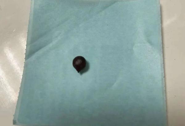 7岁孩子将黄豆塞入耳朵，三个月后已发芽……医生提醒→