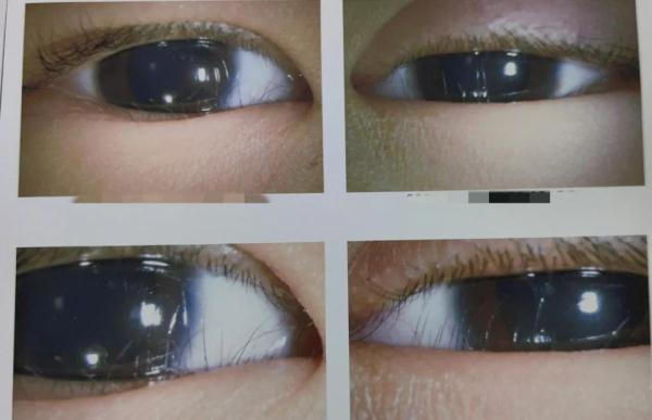 11岁男孩总爱揉眼睛，竟致眼皮下垂！医生提醒