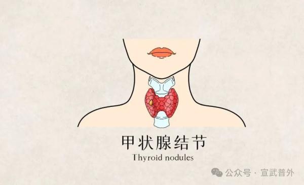 甲状腺结节,不是儿戏! 甲状腺结节,不是儿戏!