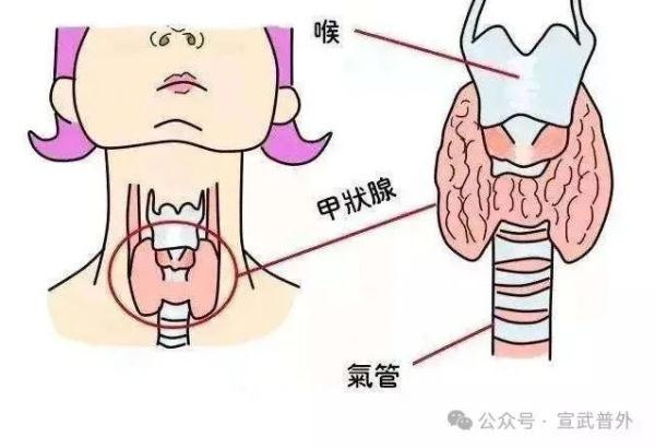 甲状腺结节,不是儿戏! 甲状腺结节,不是儿戏!