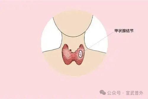 甲状腺结节,不是儿戏! 甲状腺结节,不是儿戏!