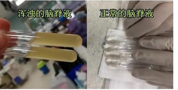 冰箱里的隔夜披萨，竟让她得上脑膜炎！这个杀手你认识它吗？