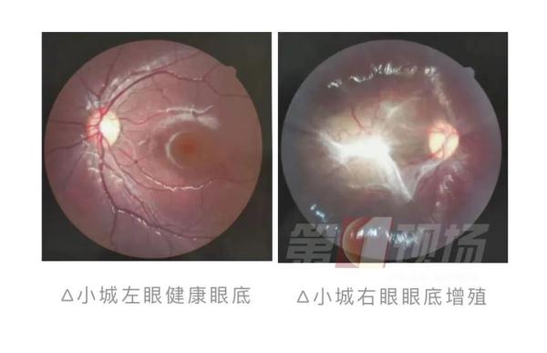 家有“哈基米”注意!7岁娃眼里长虫,只因这个习惯… 家有“哈基米”注意!7岁娃眼里长虫,只因这个习惯…