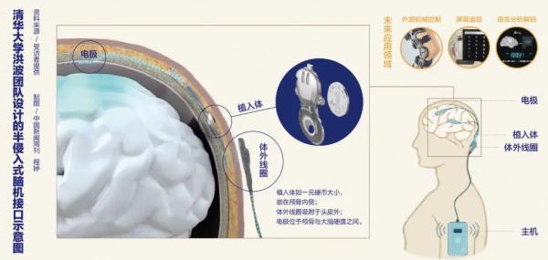 脑机接口或让脊髓损伤、渐冻症患者等受益 脑机接口或让脊髓损伤、渐冻症患者等受益