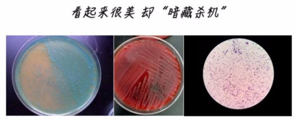 冰箱里的隔夜披萨，竟让她得上脑膜炎！这个杀手你认识它吗？