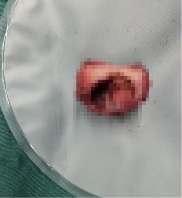 女大学生痛到满床打滚！一查医生都惊了，肚子里发现“异物”