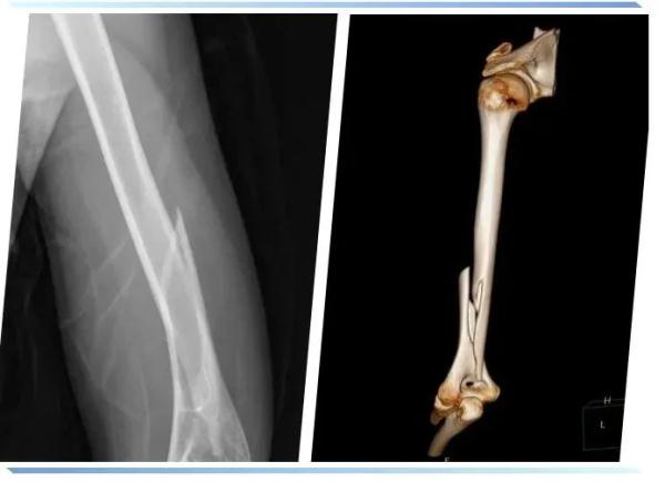 健身房“老手”撸铁深蹲,结果惨了......医生:年后已接诊近200例 健身房“老手”撸铁深蹲,结果惨了......医生:年后已接诊近200例