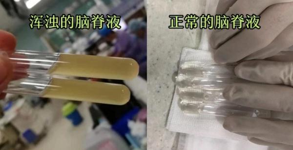 女子吃冰冻奶酪吃出脑膜炎！警惕“冰箱杀手”