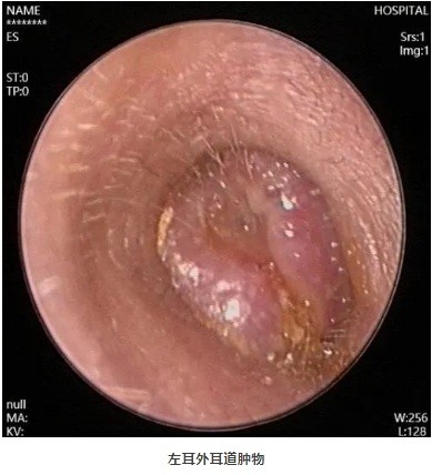 喜欢随手就挖,男子经常掏耳朵诱发外耳道癌 喜欢随手就挖,男子经常掏耳朵诱发外耳道癌