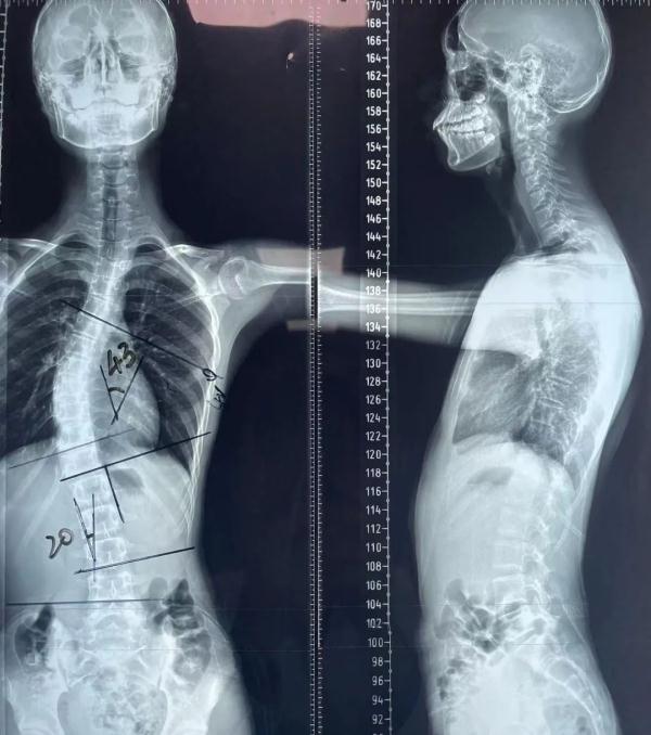 13岁少年身体在合肥被“拉直”,这个疾病要警惕 13岁少年身体在合肥被“拉直”,这个疾病要警惕