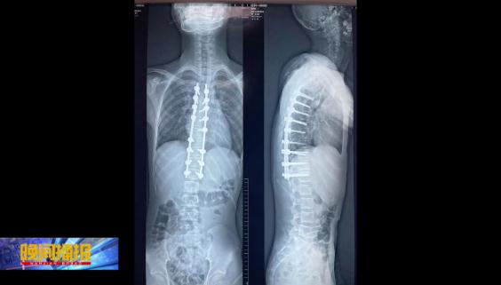 13岁少年身体在合肥被“拉直”,这个疾病要警惕 13岁少年身体在合肥被“拉直”,这个疾病要警惕