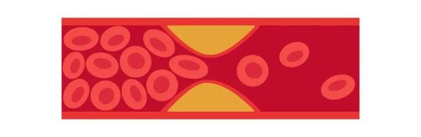 抬腿1分钟，自测血管堵没堵！如果你是这类人群，不妨试试