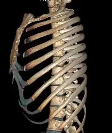 不是段子！女子咳嗽致肋骨骨折