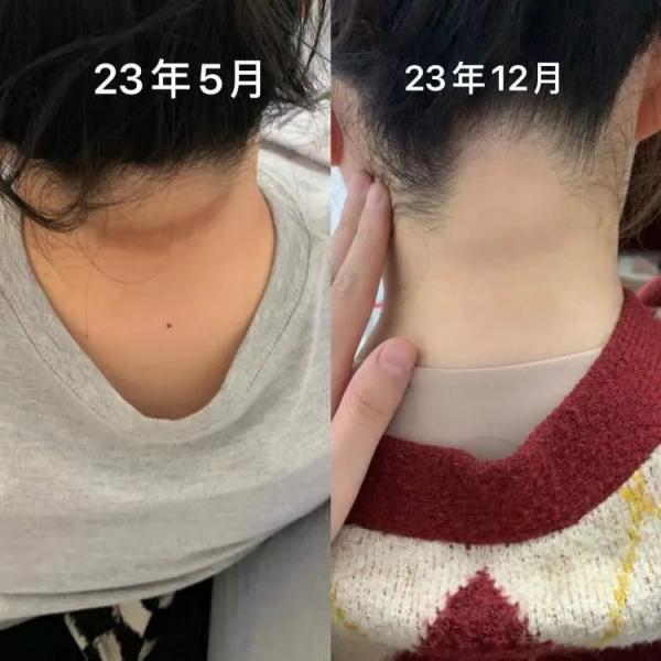 现实版“热辣滚烫”，日行7000步也能瘦？7个月减了近百斤