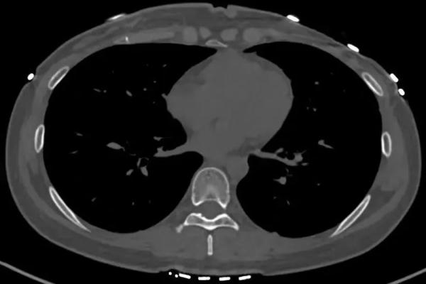 不是段子！女子咳嗽致肋骨骨折