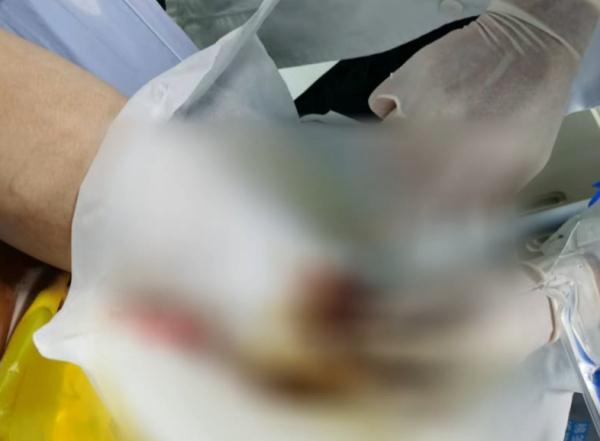 致命危“鸡”!女子被鸡啄了一下住进ICU…… 致命危“鸡”!女子被鸡啄了一下住进ICU……