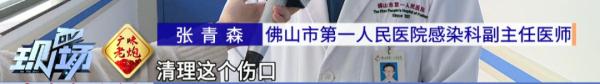 致命危“鸡”!女子被鸡啄了一下住进ICU…… 致命危“鸡”!女子被鸡啄了一下住进ICU……