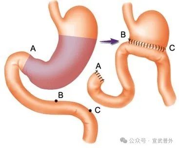 胃部术后要预防“倾倒综合征”