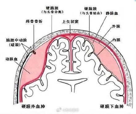 什么是硬膜下血肿