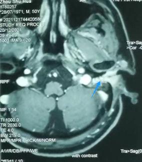 快住手！男子经常掏耳朵，10年后竟长出了癌……