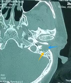 快住手！男子经常掏耳朵，10年后竟长出了癌……