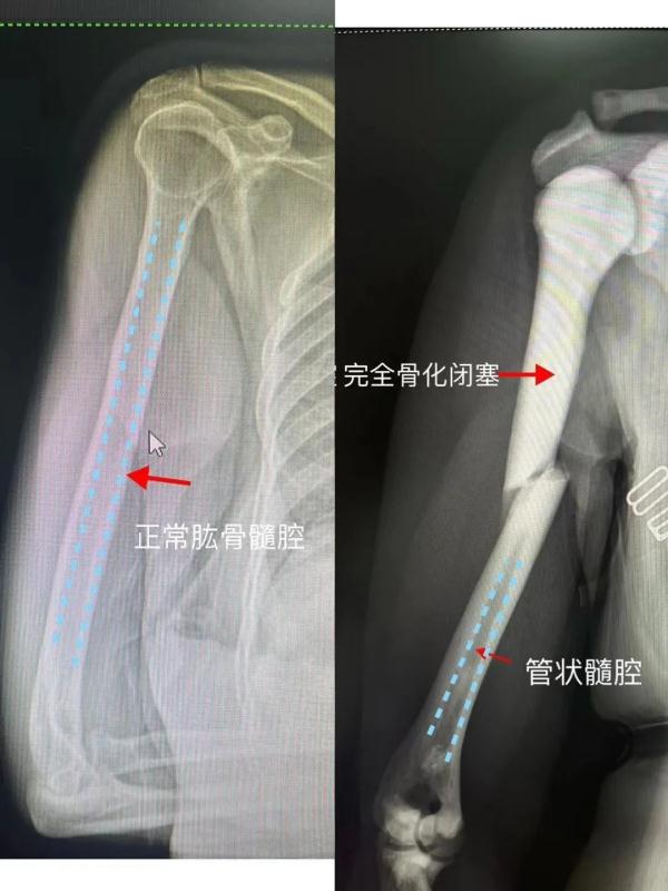 “钢针都难以穿过，电钻钻到骨头冒烟！”这种病，发病率约为百万分之一