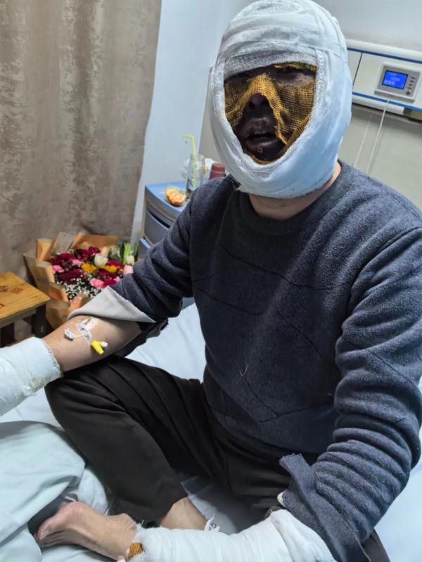 邻居失火！大叔救出两个孩子，自己被严重烧伤