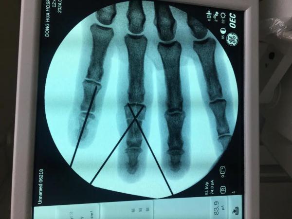 别不当回事!有人因0.5cm的伤口险遭截肢…很多人都忽视了 别不当回事!有人因0.5cm的伤口险遭截肢…很多人都忽视了